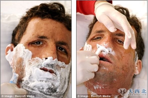 土耳其换脸人尤格尔-阿卡在接受面部移植手术后第一次刮胡子
